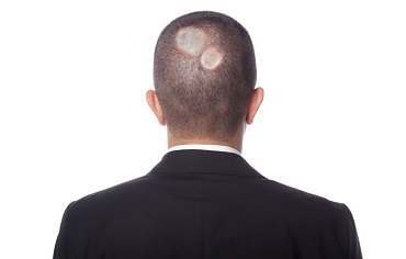 Getting rid of scalp ringworm infections